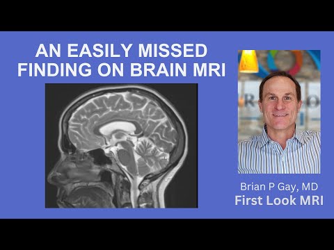 AN EASILY MISSED FINDING ON BRAIN MRI