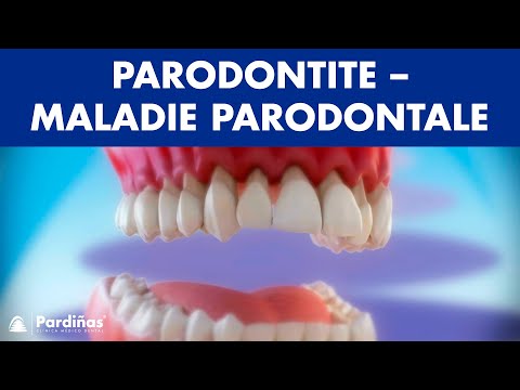 Parodontite – Maladie parodontale ©