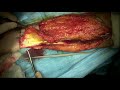 Radial forearm free flap with venous flux redirection
