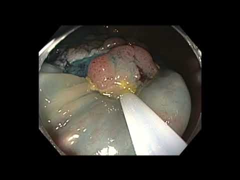 Colonoscopy: Cecum - LST-G Tumor EMR