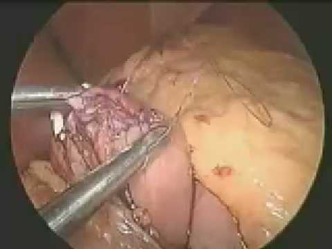 GaBP Ring Autolock™- Gastric By-Pass obesity surgery
