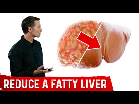 4 Critical Tips to Reverse a Fatty Liver – Dr Berg