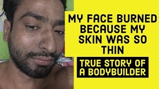 My Face burned, because my skin was paper thin | TRUE STORY