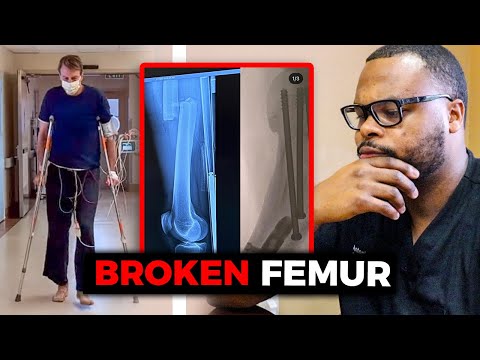 Orthopedic Surgeon Reacts to Tony Hawk's Femur Fracture