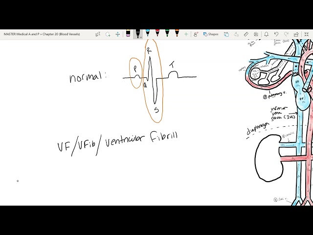 Vi Fib Understanding Heart Rhythms: Normal, Ventricular Fibrillation, and ...