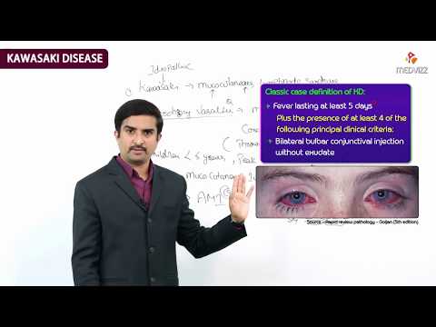 Kawasaki disease (KD), or mucocutaneous lymph node syndrome USMLE Step 1 : Dr G Bhanu Prakash