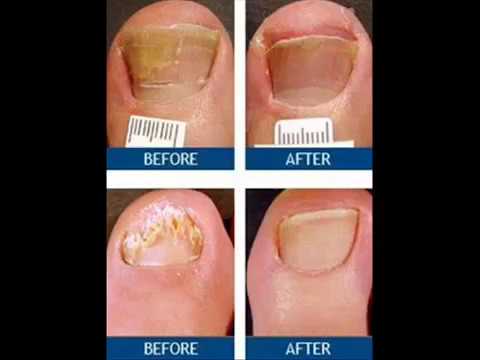 Nail Fungus Laser Treatment Dallas Texas 800 672 0625