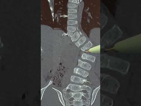 Scoliosis with Hemi vertebra : Treatment options : when surgery should be done
