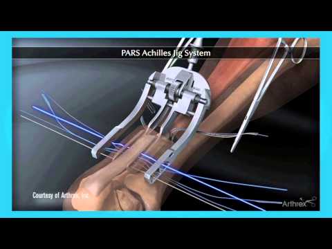 Loyola patient rebounds with minimally invasive Achilles tendon surgery