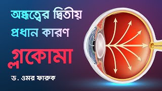 গ্লকোমা ও এর চিকিৎসা | GLAUCOMA & ITS TREATMENT | Dr. Omar Faruq | Glaucoma Specialist & Surgeon