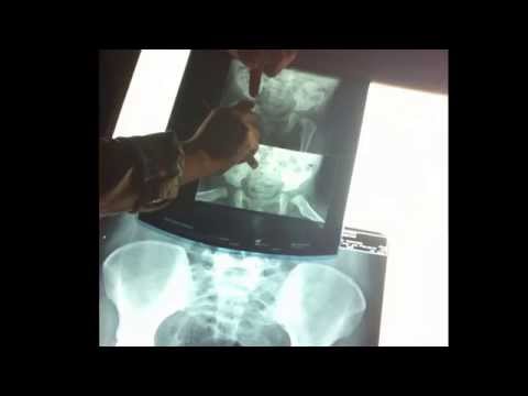 Pulseras con osteoartritis de la articulación de la muñeca Los métodos tradicionales de tratamiento de los quistes del cuello