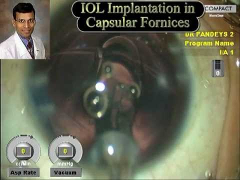 Managing Pediatric Traumatic Cataract with Torn Anterior Capsule