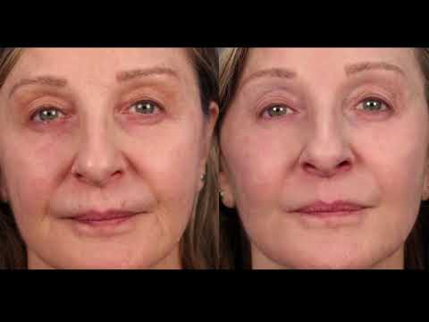 CityLine PRP Vampire Lift Nov 28
Video Thumbnail