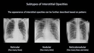 How to Interpret a Chest X-Ray (Lesson 7 - Diffuse Lung Processes)