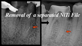 Download lagu Removal of ProTaper F3 separated in the MB canal of #46 mp3