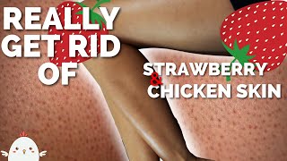 HOW TO GET RID OF STRAWBERRY LEGS | No More Bumpy Skin, Keratosis Pilaris (kp), or Chicken Skin
