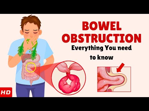 Bowel Obstruction – Causes, Signs and Symptoms, Diagnosis & Treatment