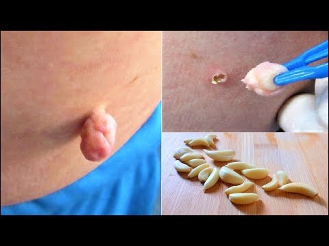 ضعي منها على الثالول ستزول الزوائد الجلدية في 24 ساعة للأبد