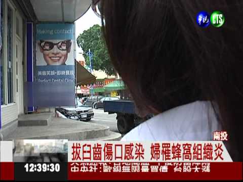 拔臼齒沒消腫 婦罹蜂窩組織炎