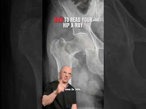 Become a Hip X-ray Reading Expert⁉️