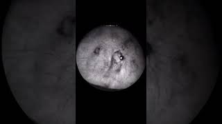 Download lagu Vitreous Opacities | Eye Floaters #shorts mp3 Download lagu Vitreous Opacities | Eye Floaters #shorts mp3