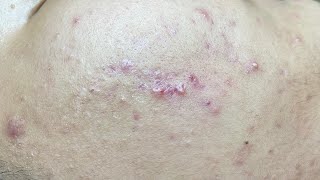 Satisfying Pimple Extraction | Deep Blackheads & Clogged Pores #638 P2
