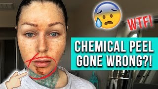 CHEMICAL PEEL GONE WRONG?! Where have I been? | KristenLeanneStyle