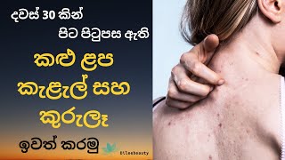Get Rid of Back Acne & Pimples in 30 Days  sinhala with Dileebeauty 💕💕