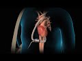 Left Ventricular Assist Device | LVAD | Nucleus Health