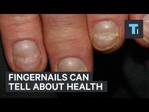 Your Fingernails Say More About Your Health Than You Think