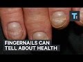 Fingernails can tell about health