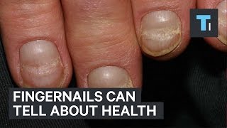 Fingernails can tell about health