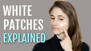 WHITE PATCHES ON THE FACE EXPLAINED (PITYRIASIS ALBA)| DR DRAY