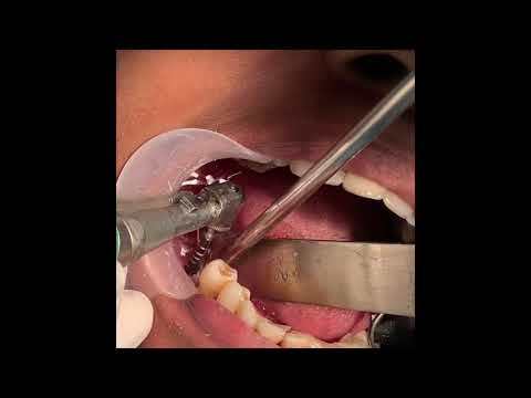 Atraumatic Quick Placement Of Two Dental Implants