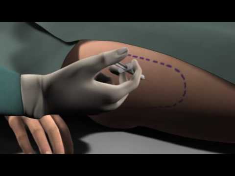 liposuctie buik video liposuctie buik video
