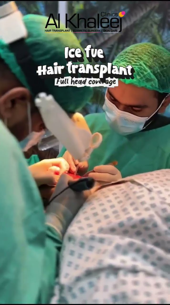 From bald to full ICE-FUE hair transplant coverage results at AlKhaleej Clinics