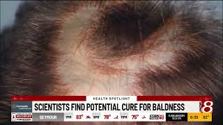 Scientists find potential cure for baldness