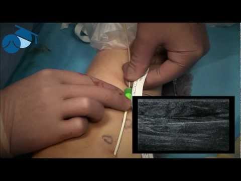 Radiofrequency (RFA) closure of a recurrent Great Saphenous Vein (GSV) - varicose veins