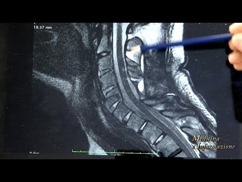 Come riconoscere un ernia del rachide cervicale Che per il trattamento a basso farmaci mal di schiena e quali unguenti