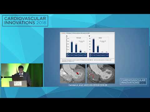 CVI2018 Session: CT imaging for TAVR beyond area and perimeter - Joao Cavalcante, MD