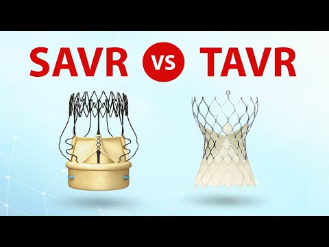 SAVR vs.  TAVR Patient Webinar: What Should Patients Know?