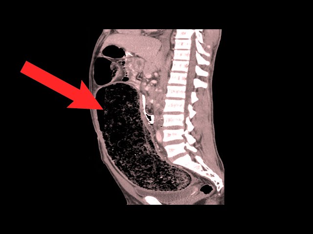 Why You Should Be Careful With Psyllium Husk Fiber Supplement SDDEFAULT Thumbnail