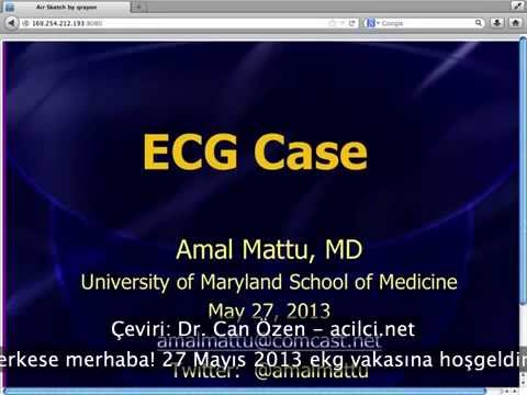 Mattu EKG Vakası: AV Bloklar - 27 Mayıs 2013 (Türkçe Altyazılı)