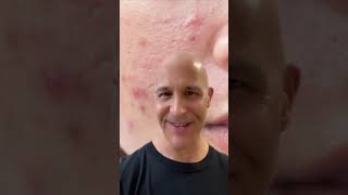 Heal Your Acne | Dr. Mandell  #shorts