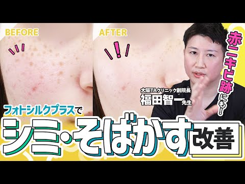 【シミ・そばかすを消す】フォトフェイシャルの進化版の光治療！その効果やダウンタイムを徹底解説します。【大阪TAクリニック】