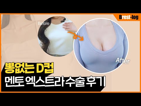 가슴성형 브이로그 | 상담부터 당일 통증 후기까지 | 멘토 엑스트라 스무스 보형물 촉감 | 윈느성형외과 라벨윈느 유튜브 영상