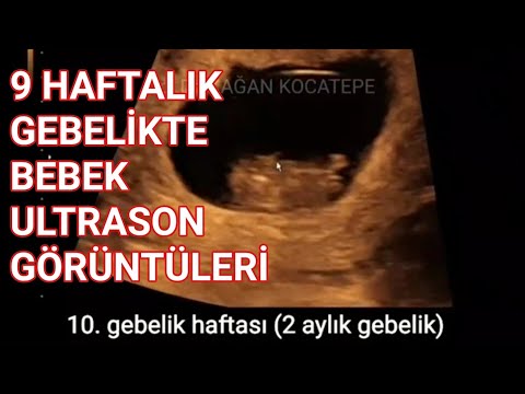 9 hafta 1 günlük (2 aylık) gebelikte bebek ultrasonografide nasıl görünür,boyu nasıldır?(açıklamalı)