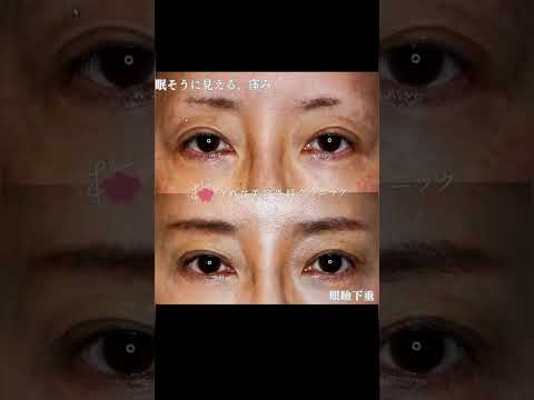 医学科 50代　眼瞼下垂手術