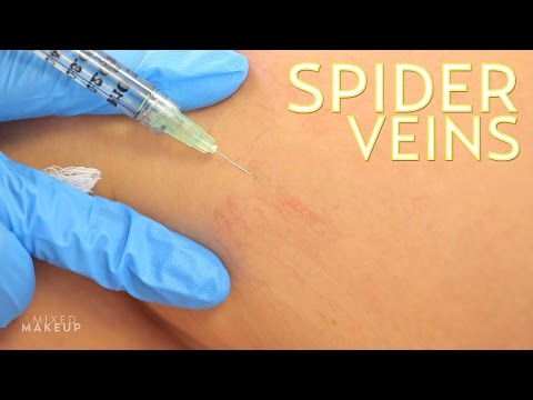 The Best Spider Veins Treatment | The SASS with Susan and Sharzad Video