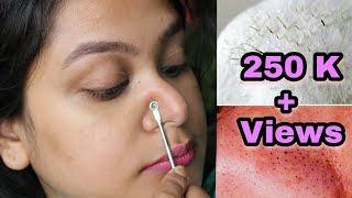 HOW TO REMOVE BLACKHEADS INSTANTLY &amp; PERMANENTLY | PAINLESS HOME REMEDY
